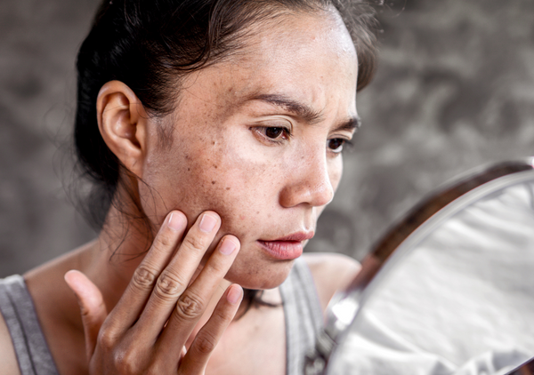 Melasma vs Acne: What Are the Differences and How to Treat Them?