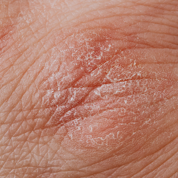 What Is Eczema & The Products You Need