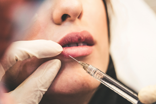 What To Consider Before Having Juvederm Dermal Filler