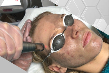 Spectra Carbon Peel aka The Hollywood Peel