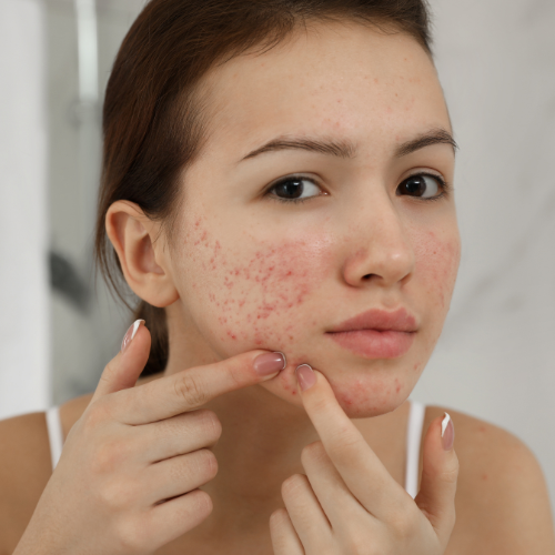 Fungal vs Hormonal Acne: How to Tell the Difference