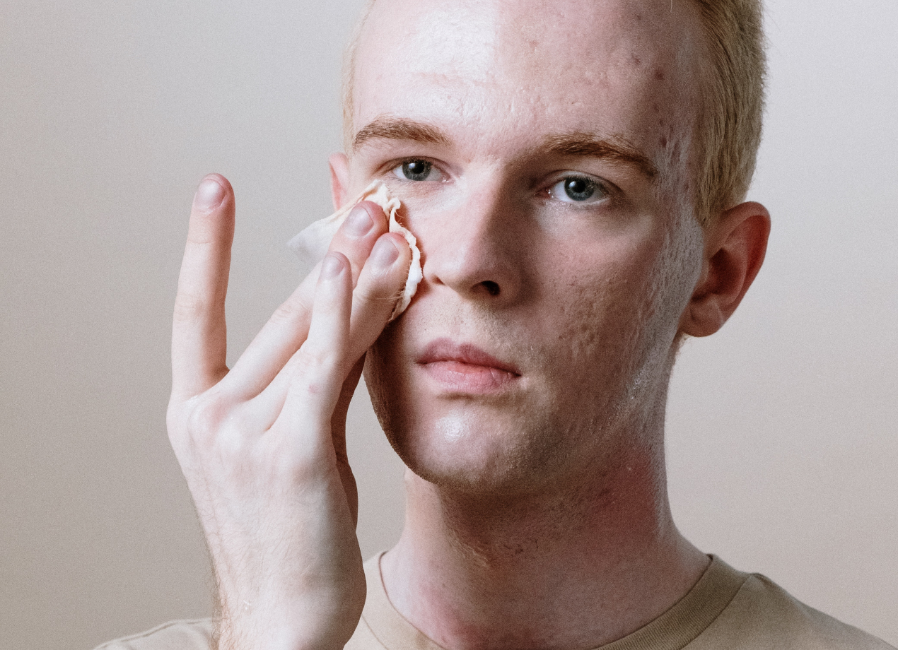 What are acne scars