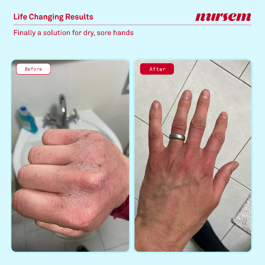 Before and after comparison of dry, sore hands with visible improvement after using a product from 'nursem'.