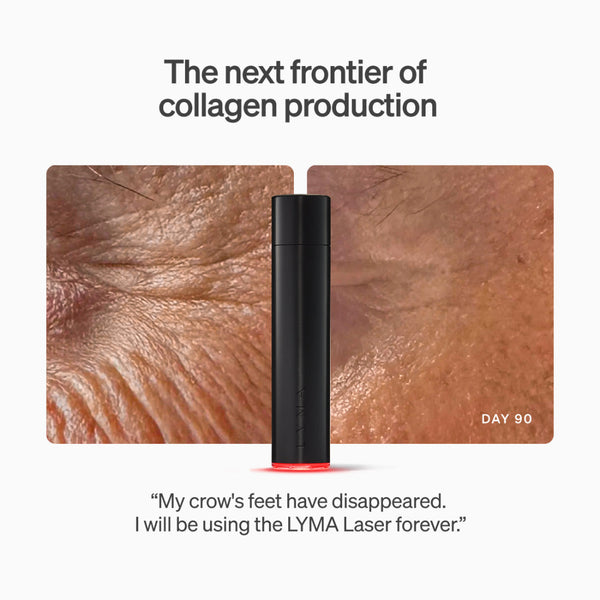 A black cylindrical LYMA laser device stands centered between two close-up skin texture panels labeled DAY 90, with marketing text above and a customer quote below on a light gray background.