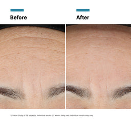 Before and after comparison of skin texture on a forehead.