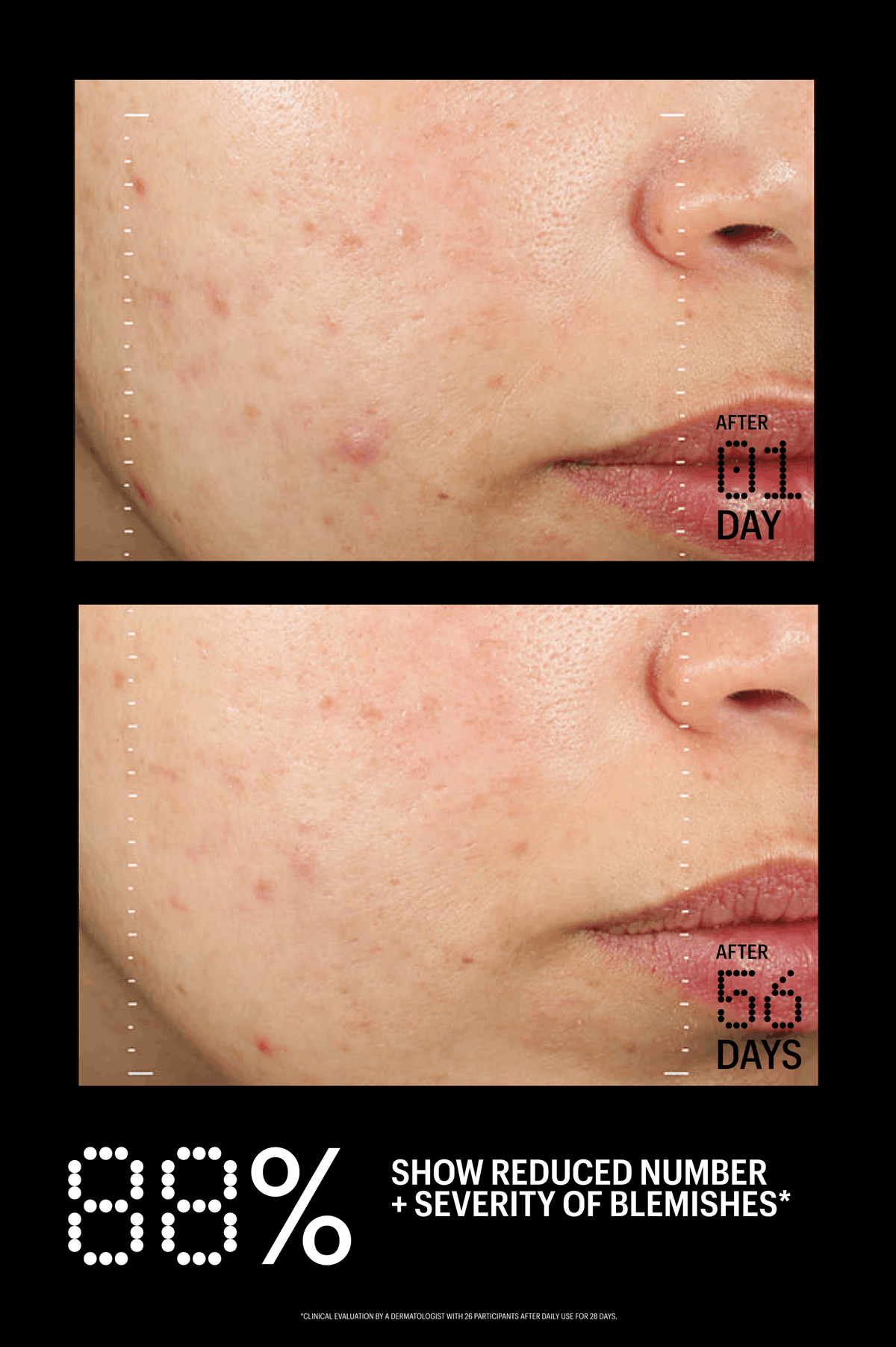 Before and after comparison of acne treatment on a person's face with text indicating improvement over 56 days.