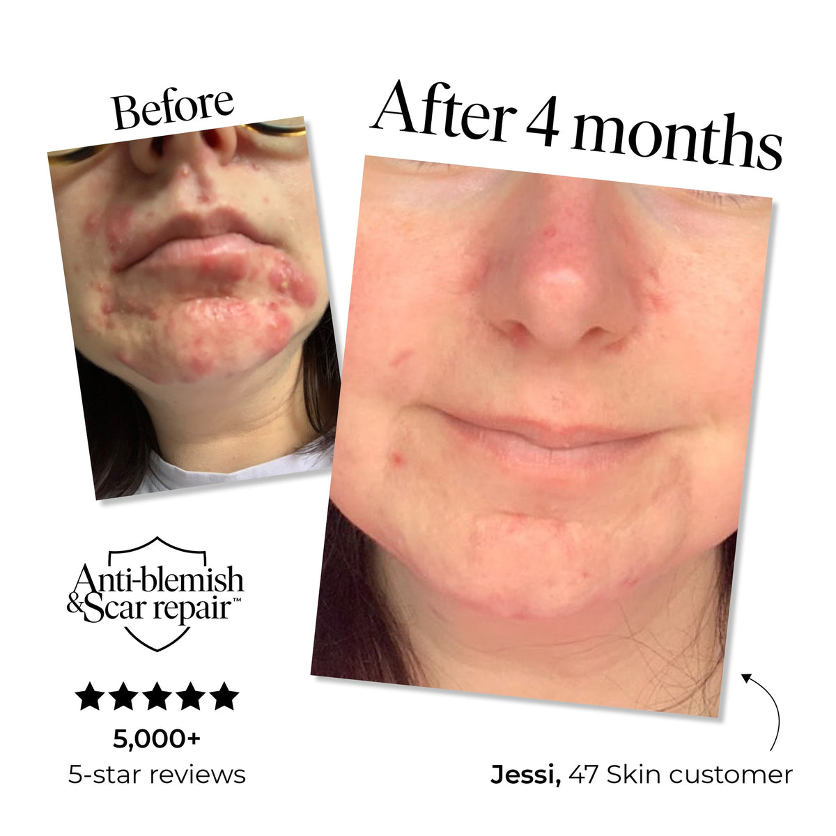 47 Skin Exfoliating Skin Treatment for Stubborn Acne 30ml