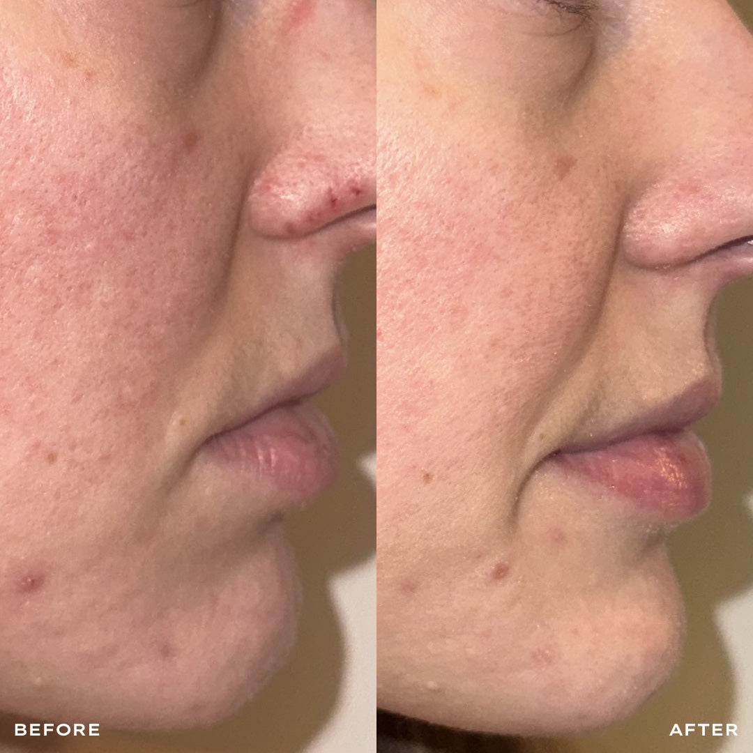 Before and after comparison of a person's face with acne on the left side and smooth skin on the right side.