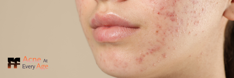 teenage acne