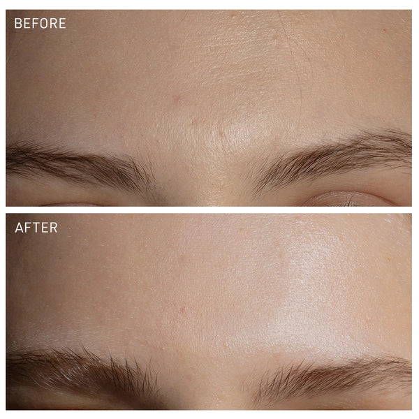 Before and after comparison of a skin treatment on a person's face.