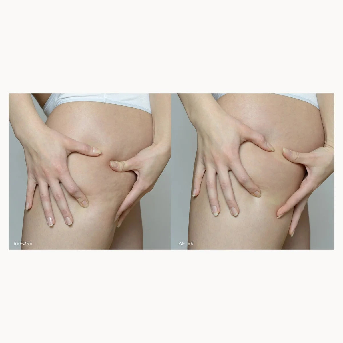 A side-by-side before and after comparison showing a person's hip and upper thigh area, with the left side displaying more visible skin folds and the right side appearing smoother and tighter.